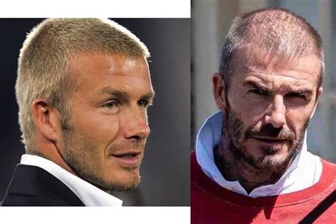 David Beckham Hair Loss: Investigating the Facts – nicehair.org