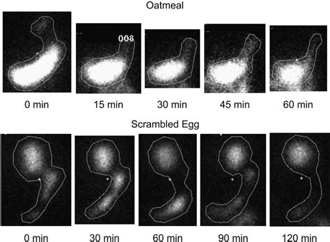 Figure 2 from The Gastric Emptying Study: Protocol Design ...