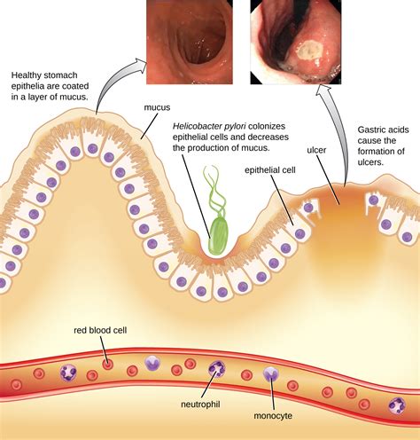 Peptic Ulcer Disease | Concise Medical Knowledge