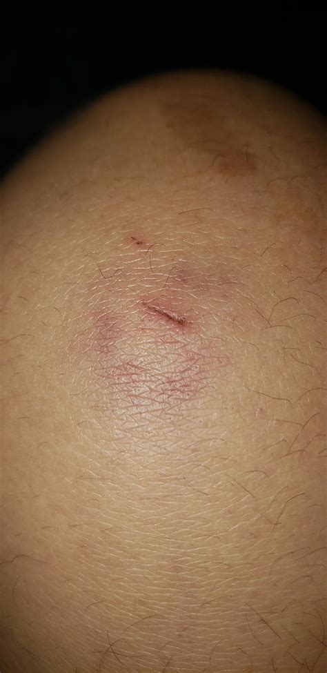 24yo [M] I noticed this cut today on my knee and am wondering if it looked infected, the area ...