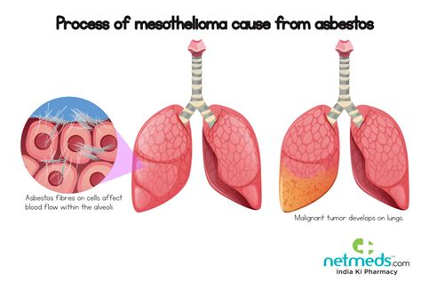 Mesothelioma: Causes, Symptoms and Treatment