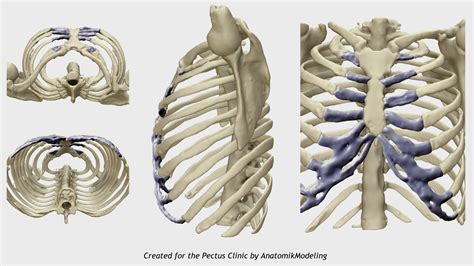 Pectus Deformity Chest