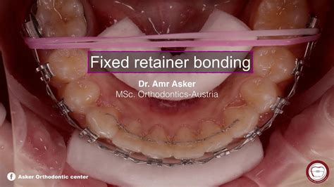 fixed permanent retainer bonding in orthodontics by dr. Amr asker - YouTube