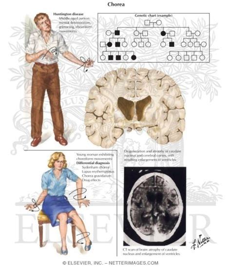 Symptoms - Huntington's Disease