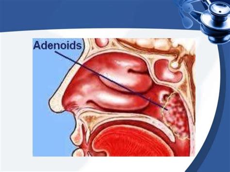 Adenoidectomy