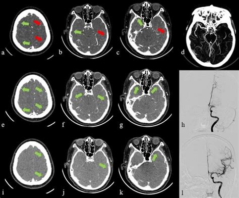 A 65-year-old male patient with acute ischemic stroke due to occlusion ...