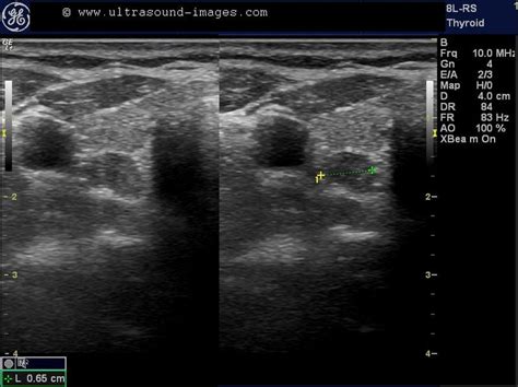 A Gallery of High-Resolution, Ultrasound, Color Doppler & 3D Images - Thyroid-2