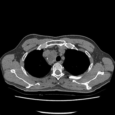 Pre contrast CT scan demonstrates well-defined right paratracheal mass ...