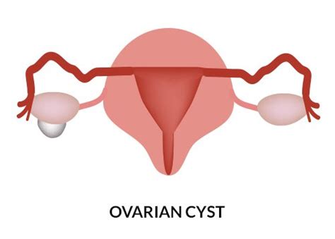 Enlarged Uterus | Causes & Symptoms of Swollen Uterus