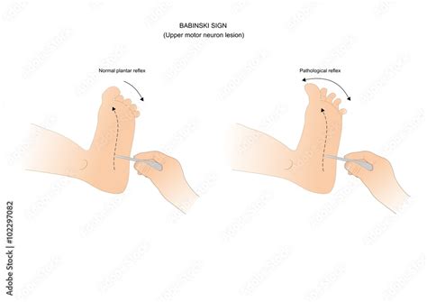 test for a possible motor neuron lesion: the babinski sign Stock Vector | Adobe Stock