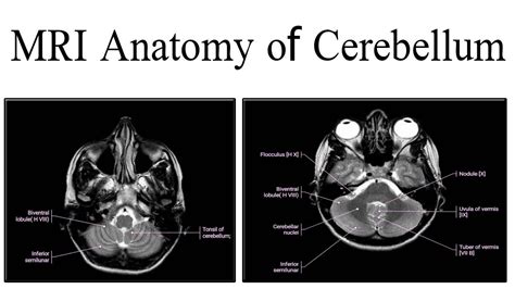 MRI Anatomy of cerebellum - YouTube