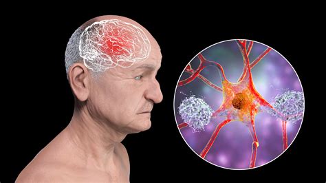 Managing Vascular Parkinsonism: Treatment and Therapy Options