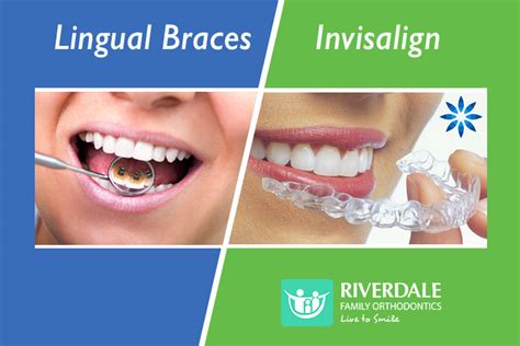 Are Lingual Braces or Invisalign Better for You?