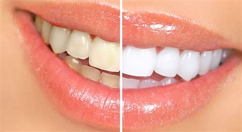 5 Home Remedies for Whiter Teeth : Human N Health
