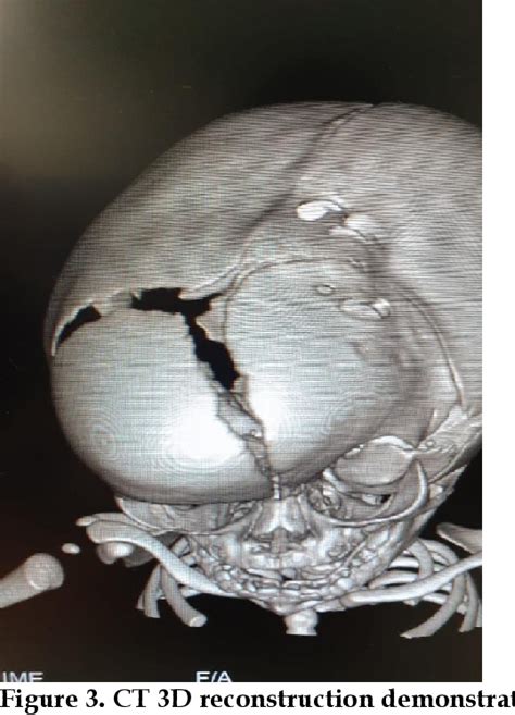 Figure 3 from Accuracy of cranial ultrasound in the diagnosis of hydrocephalus in children under ...