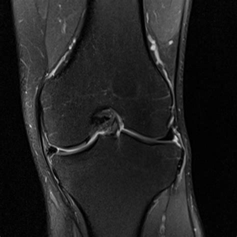 Knee MRI | trialog | a triathlon blog