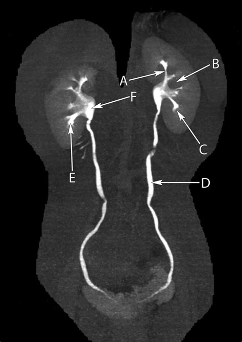 Coronal image from a computed tomography urogram | The BMJ