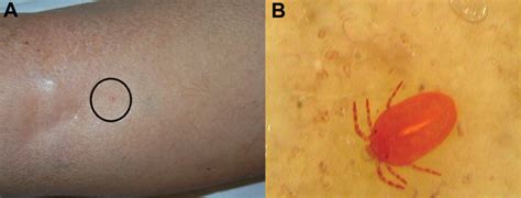 Figure - Diagnosis of Trombiculosis by Videodermatoscopy - Volume 20, Number 6—June 2014 ...