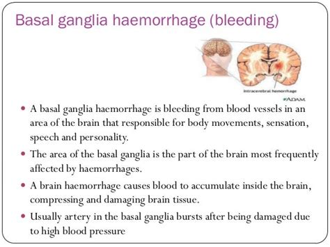 Stroke basal ganglia bleed