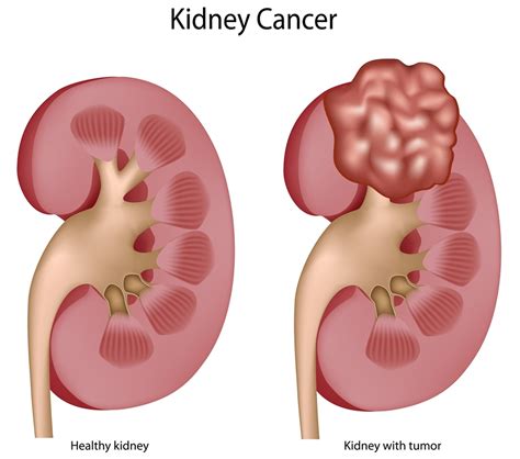 Kidney Cancer - Causes, Symptoms, Signs, Stages & Treatment