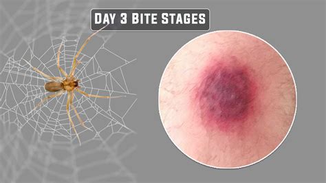 Brown Recluse Bite Stages: Day 1, 2, 3, 4, 5 (With Pictures)