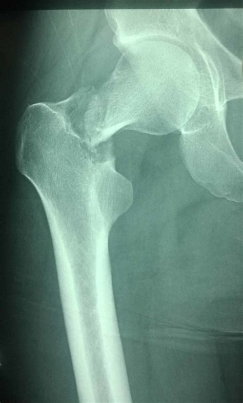 Femoral neck fracture x ray - foliowery