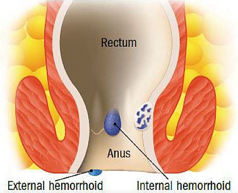 Mild Hemorrhoids Female