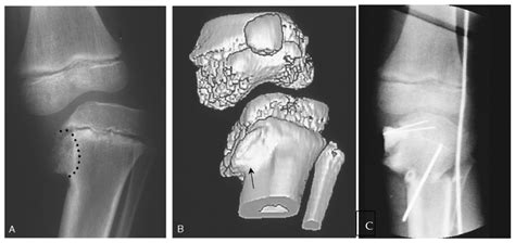 Children | Free Full-Text | Deformity Reconstruction Surgery for Blount’s Disease