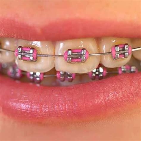 Metal braces | 32 Dental Studio