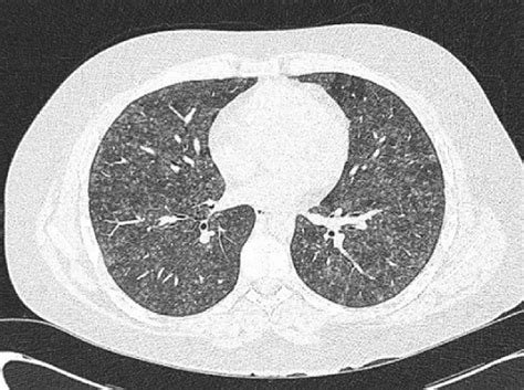 Thoracic high resolution CT scan demonstrating ground glass nodules in... | Download Scientific ...