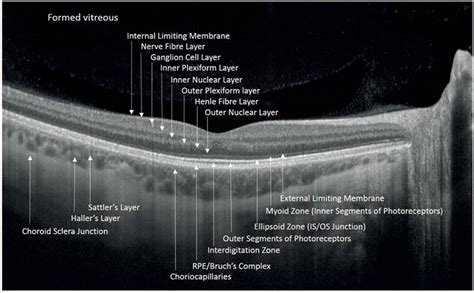 Retina and Uveitis MCQs – part 1 | Farabi Retina