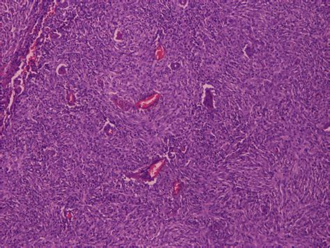 Histological section of MPNST (HEX4) | Download Scientific Diagram