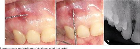 Figure 1 from Treatment of lateral periodontal cyst with guided tissue ...