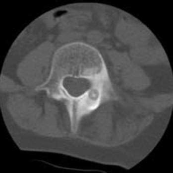 Osteoid Osteoma Skull