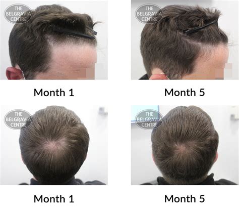 Hair Growth Success Story: "Excellent results!!"