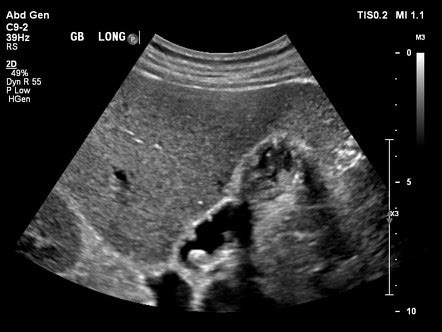 Adenomyomatosis of the gallbladder | Radiology Reference Article | Radiopaedia.org