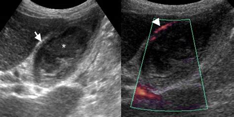 The Radiology Assistant : Gallbladder - Wall Thickening