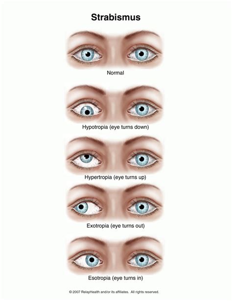 The Basics of a Strabismus Exam: