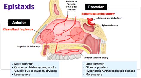 Epistaxis | Emergency medicine, Medical mnemonics, Emergency nursing