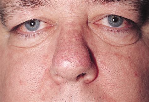 Treatment of Granuloma Faciale With the 585-nm Pulsed Dye Laser | Surgery | JAMA Dermatology ...