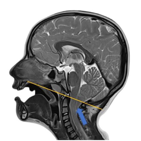 -MRI showing displacement of the cerebellar tonsils (blue arrow) below... | Download Scientific ...