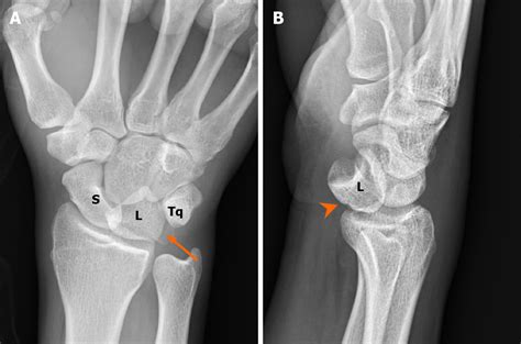 Triquetral Fracture Symptoms