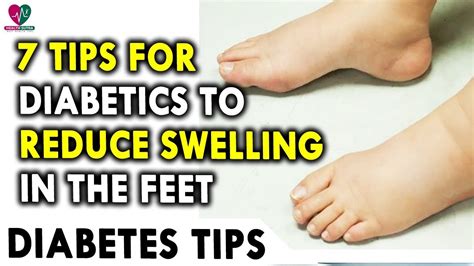 Diabetes foot swelling treatment