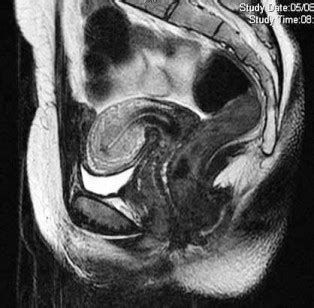 Male Pelvic Mri Anatomy