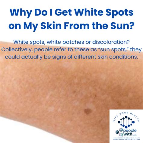 PeopleWith | News | Why Do I Get White Spots on My Skin From the Sun?