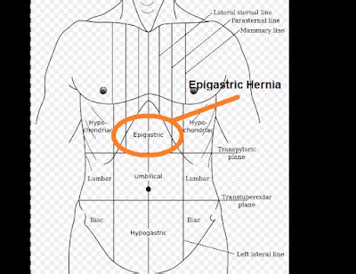 What is Epigastric Hernia | Swami Dayanand Naturopathy Hospital