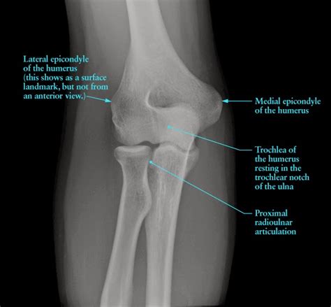 Understanding Williams Syndrome: 2014 WSA Convention Questions Answered Part 2- Radial-ulnar ...