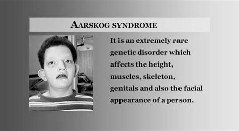 What is Aarskog-Scott Syndrome? - PT Master Guide