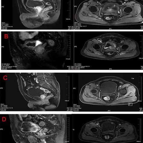 Magnetic resonance imaging of bladder cancer patient. A) MRI image... | Download Scientific Diagram