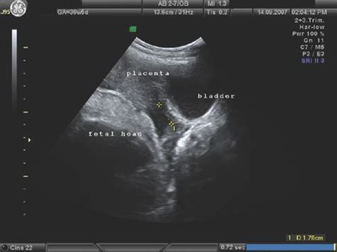 Antepartum Haemorrhage | Obgyn Key